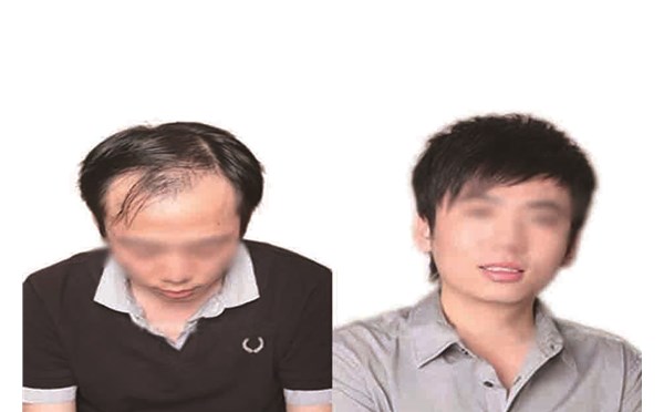 想了解为啥经常脱发吗？南阳顶美带你避掉这些坑！