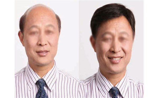 如何正确佩戴南阳假发，南阳顶美来教你！